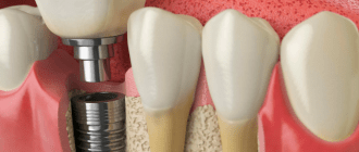 Имплантация Зубов: Профессиональный Взгляд на Сложную Процедуру