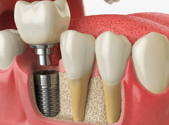 Имплантация Зубов: Профессиональный Взгляд на Сложную Процедуру